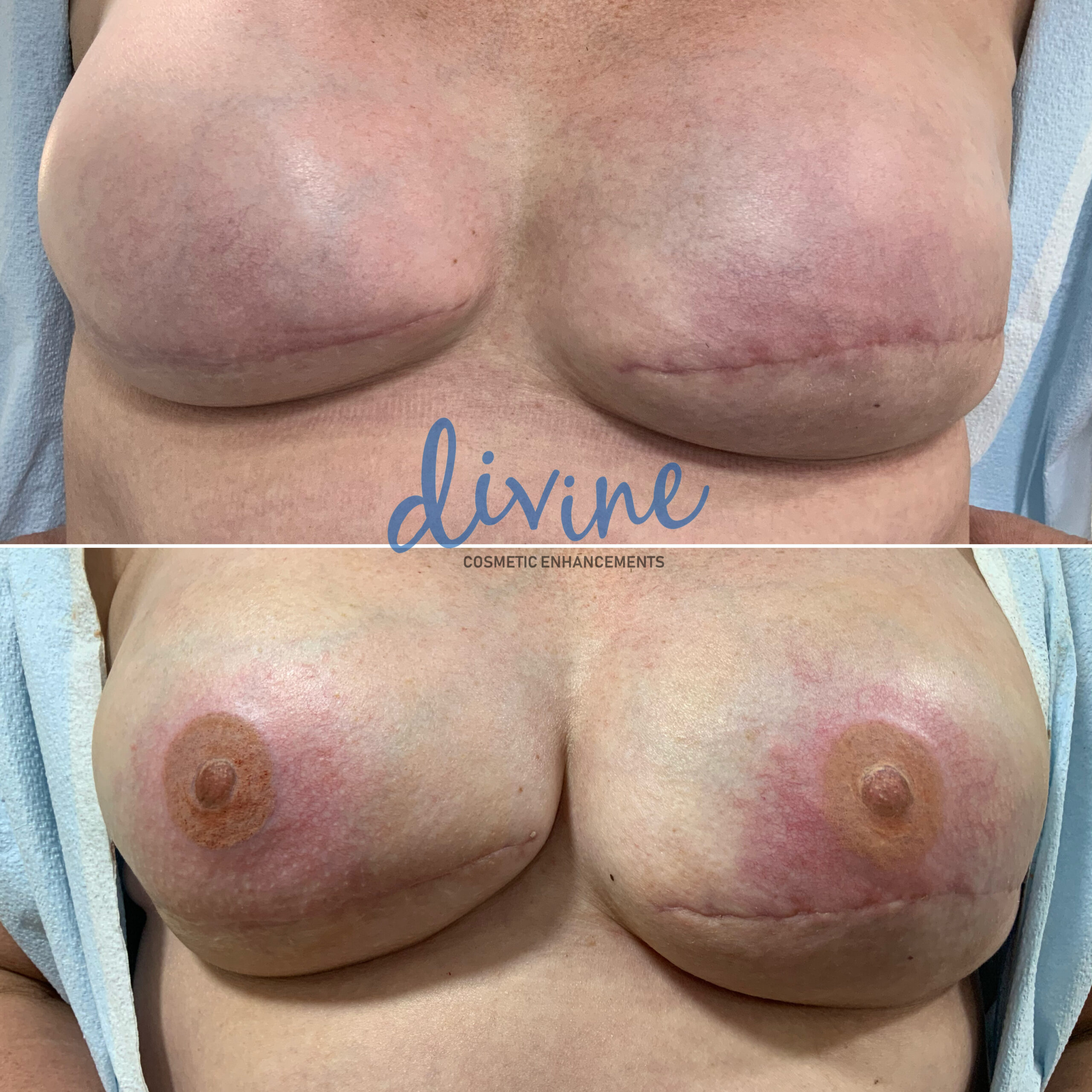 3D Areola Nipple Before and After